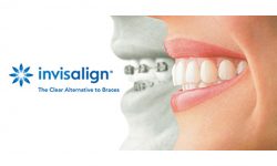 Invisalign